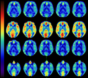 Arterial spin labeling image.